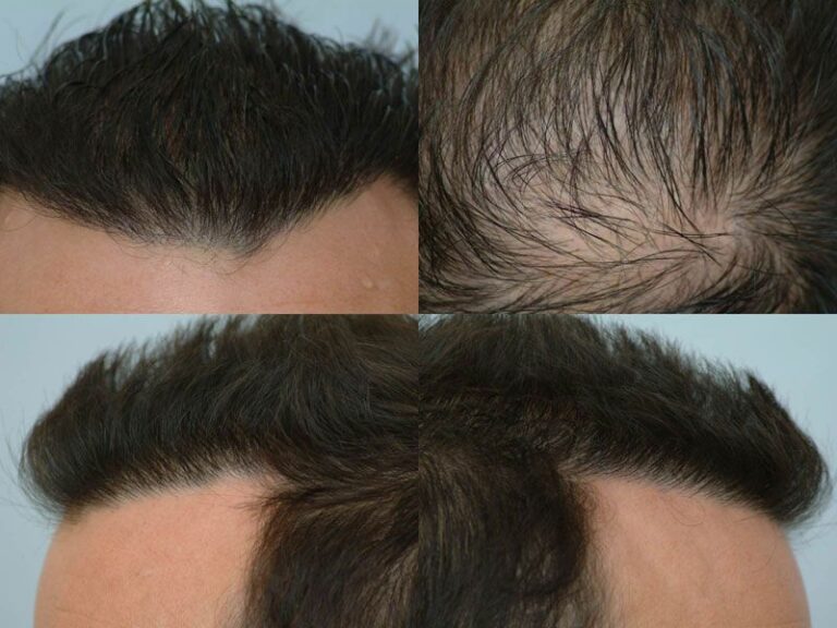 Patient DRS before & after FUE results collage 4