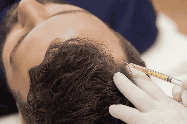 PRP treatment on man patient scalp