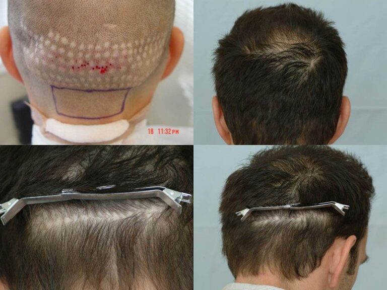Patient DRS before & after FUE results collage of donor area and scar repair