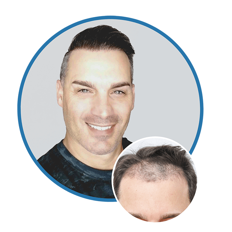 Hair Restoration Results