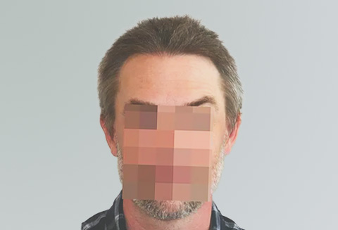 Hair Transplant 2500 grafts FUE