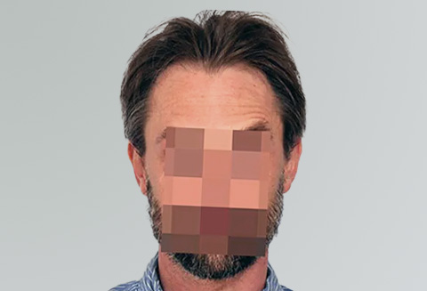 Hair Transplant 2500 grafts FUE