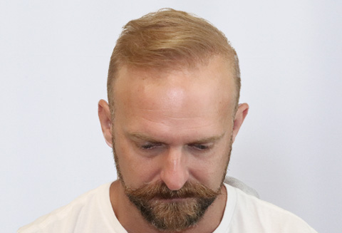 Hair Transplant 5582 grafts FUE