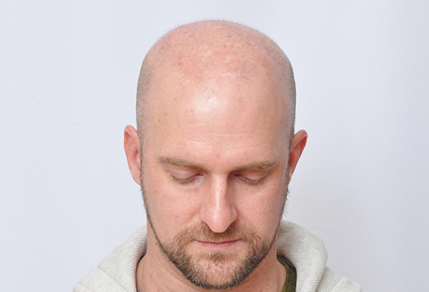 Hair Transplant 5582 grafts FUE
