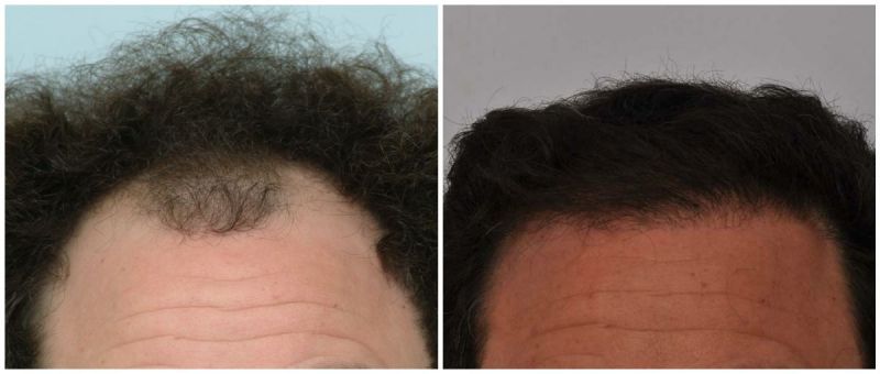 Hair Transplant 2373 grafts FUE