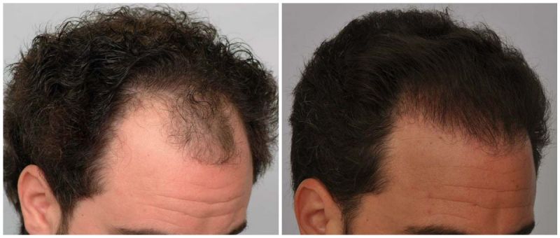 Hair Transplant 2373 grafts FUE