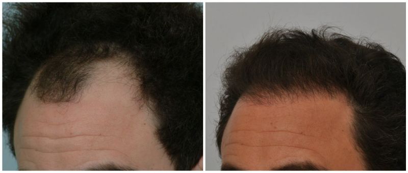 Hair Transplant 2373 grafts FUE