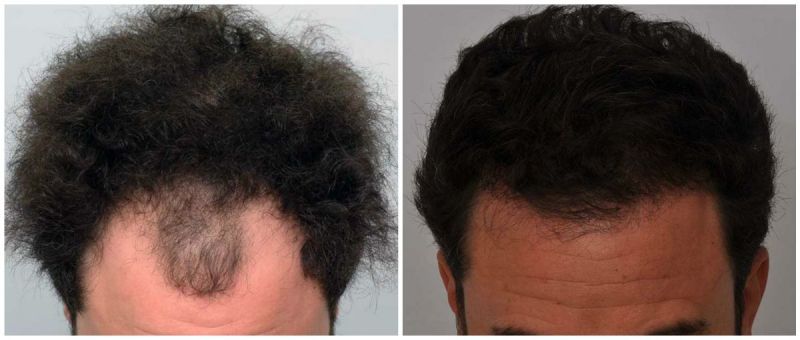 Hair Transplant 2373 grafts FUE