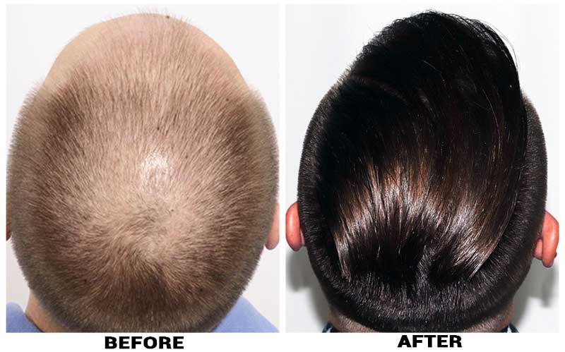 Hair Transplant 2584 grafts FUE