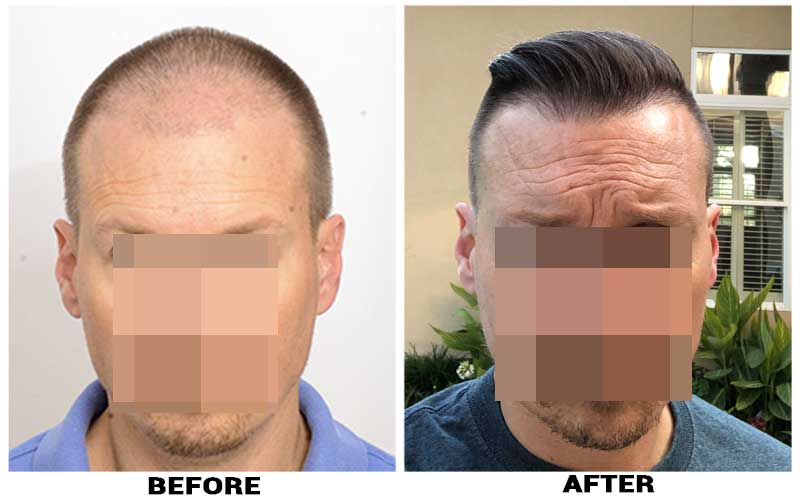 Hair Transplant 2584 grafts FUE