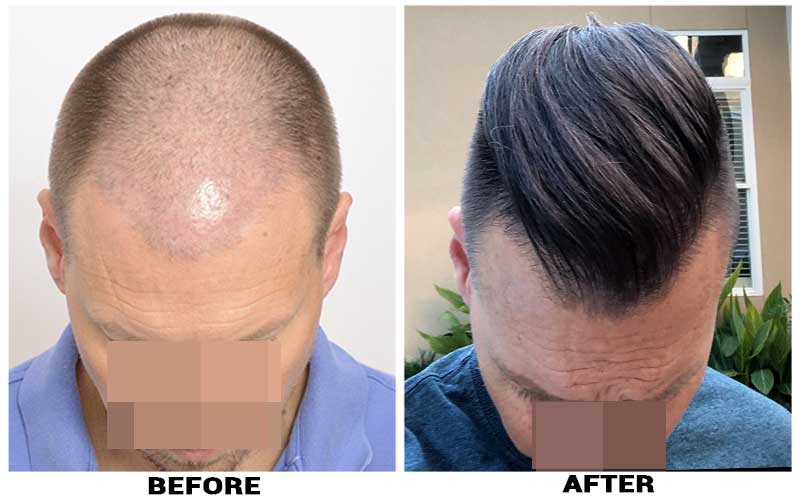 Hair Transplant 2584 grafts FUE