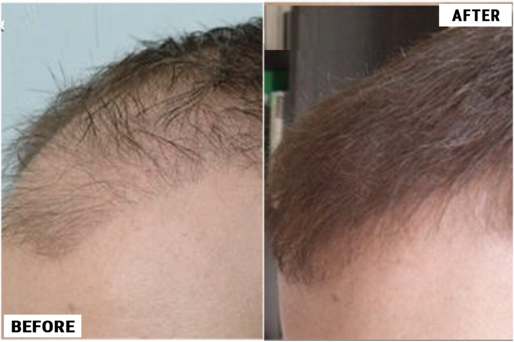 Hair Transplant 1701 grafts FUE
