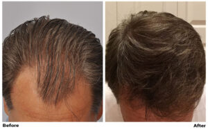 Hair Transplant 1827 grafts FUEv