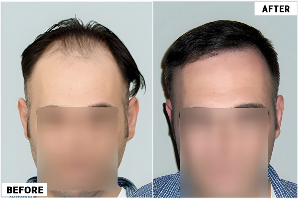 Hair Transplant 2368 grafts FUE