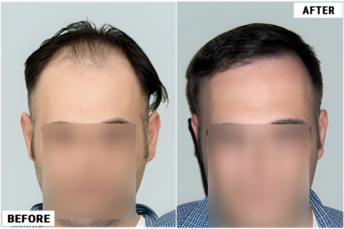 Hair Transplant 2368 grafts FUE
