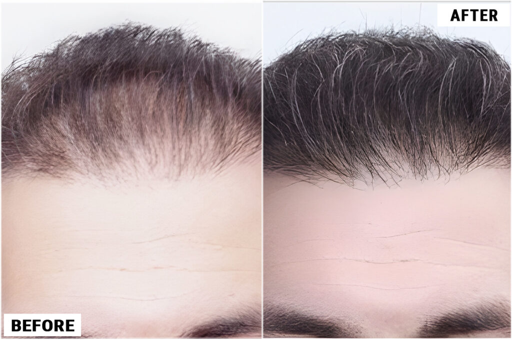 Hair Transplant 2700 grafts FUE