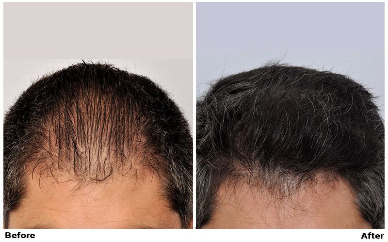 Hair Transplant 1915 grafts FUE