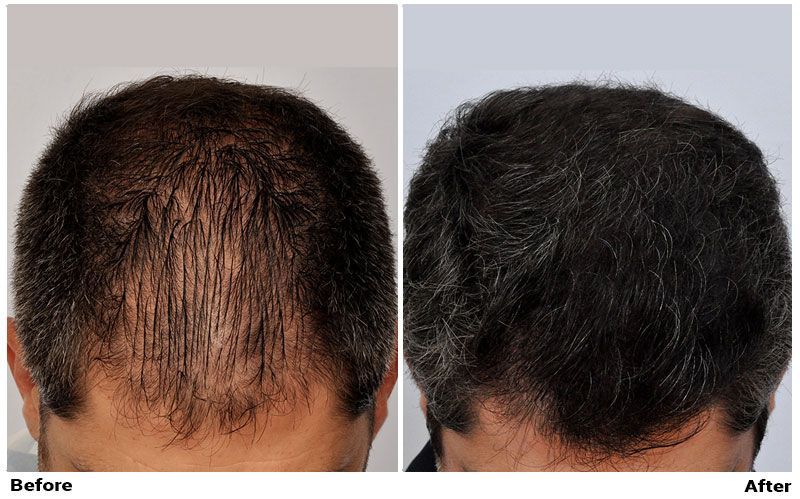 Hair Transplant 1915 grafts FUE