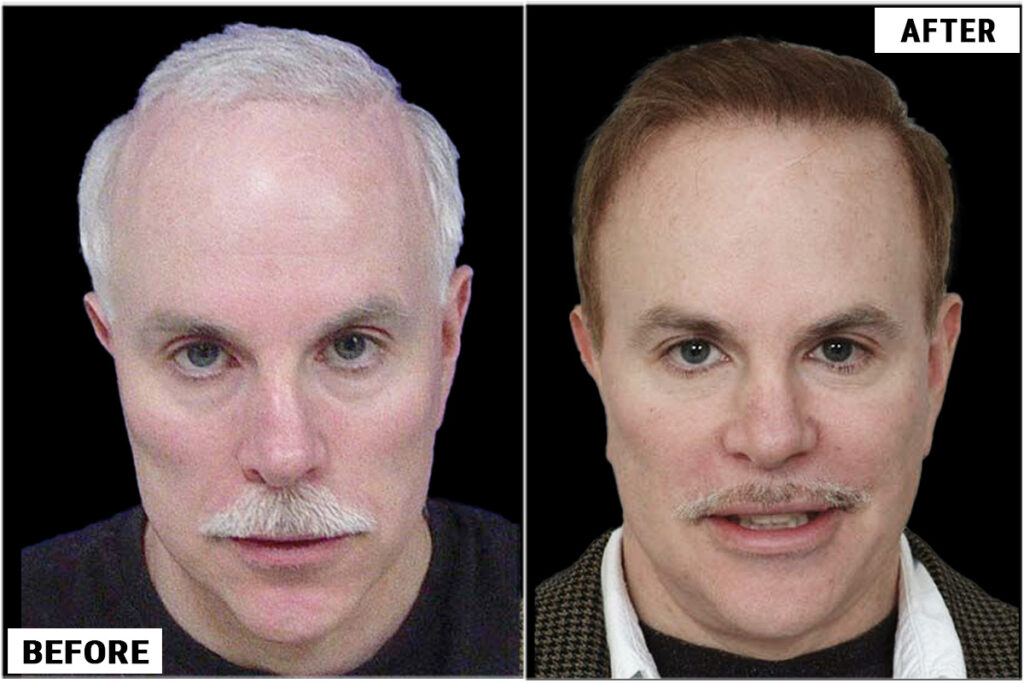 Hair Transplant 6800 grafts FUE