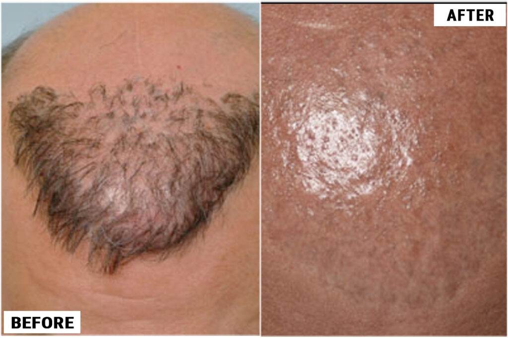 Hair Plug Removal