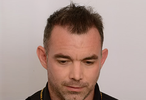 Hair Transplant 2050 grafts FUE