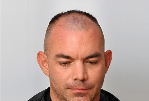 Hair Transplant 2050 grafts FUE