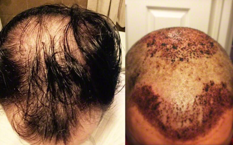 Patient OOO before and immediate post-op FUE surgery top scalp view