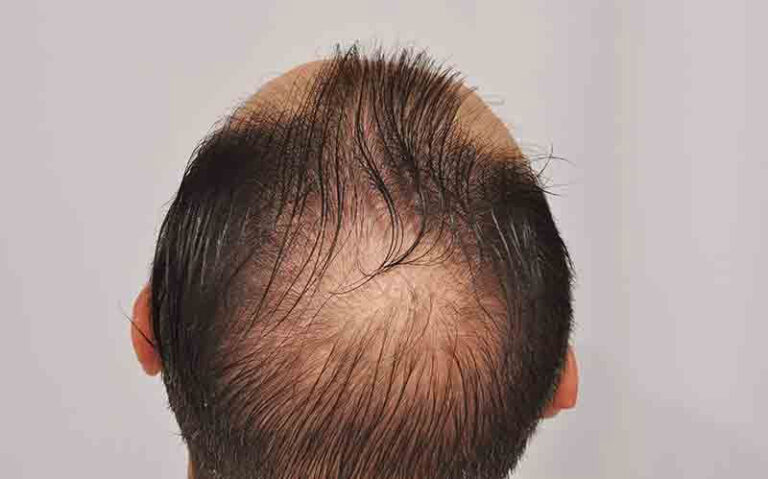 Patient OOO before FUE surgery back scalp view
