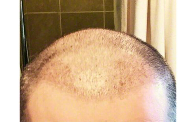 Patient OOO 14 days after FUE front scalp view