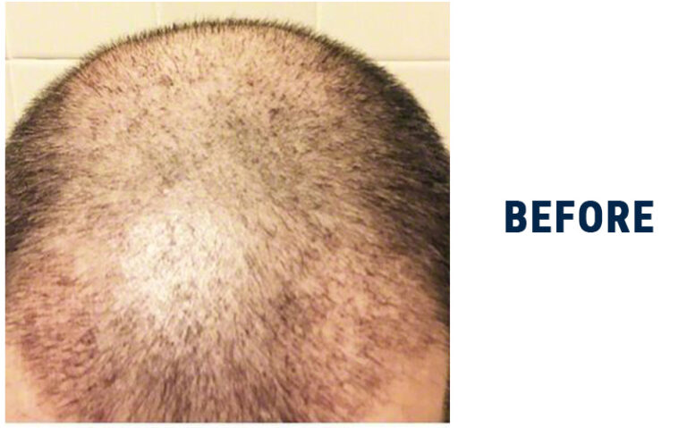 Patient OOO 14 days after FUE top scalp view