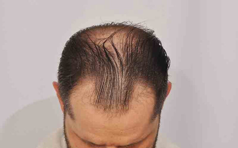 Patient OOO before FUE surgery top scalp view