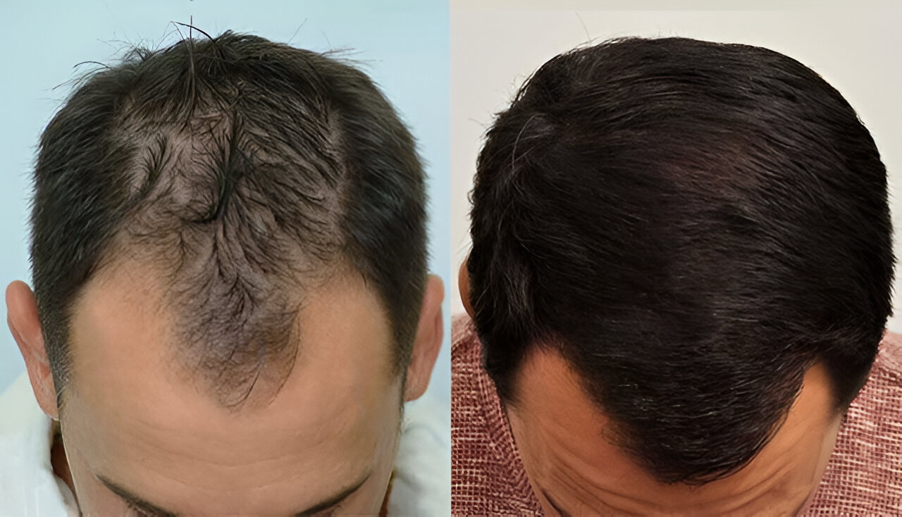 Hair Transplant 2910 grafts FUE