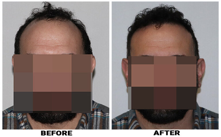 Patient RRW before & after FUE results front comparison 9