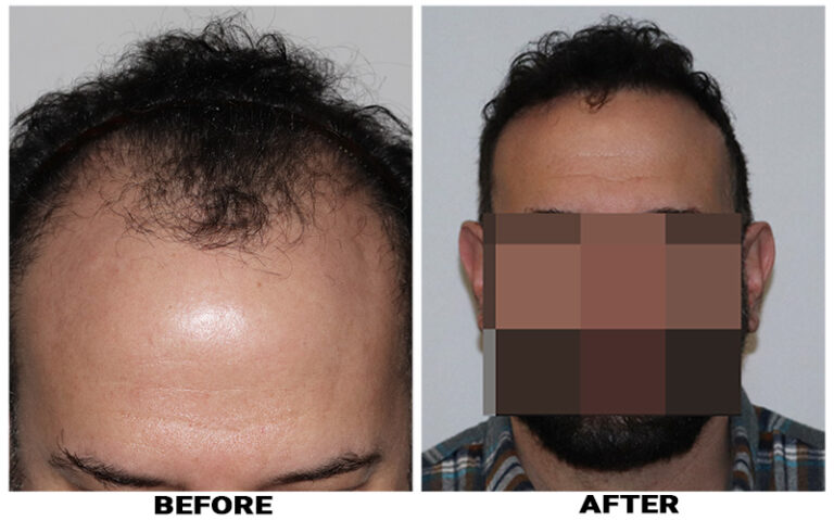 Patient RRW before & after FUE results front comparison 8