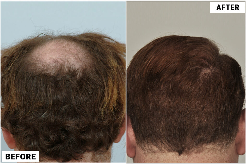 Hair Transplant 3007 grafts FUE