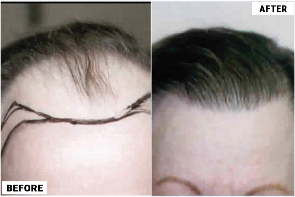 Hair Transplant 1800 grafts FUT