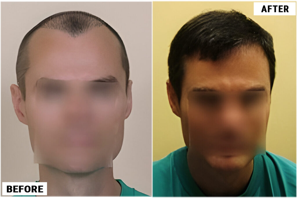 Hair Transplant 2146 grafts FUE