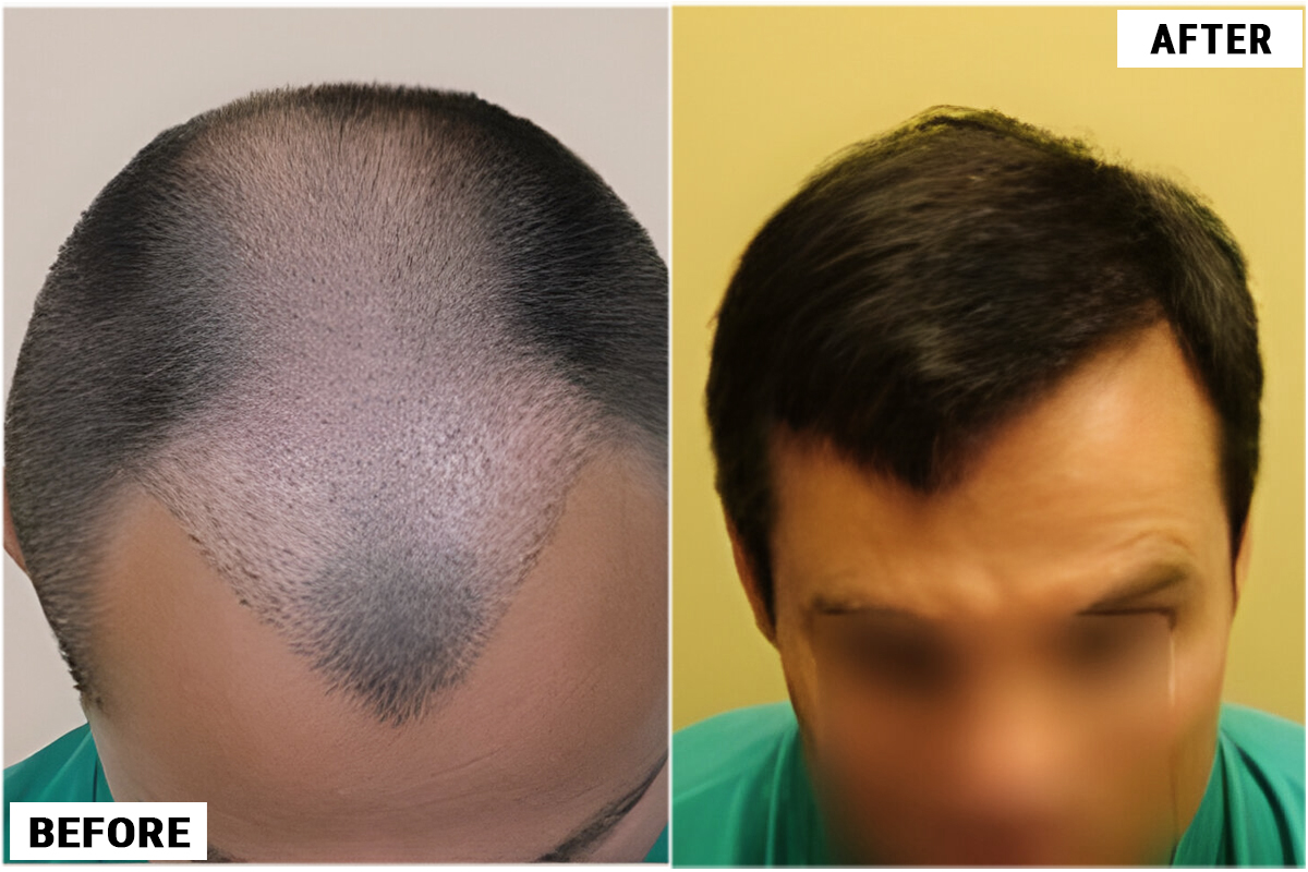 Hair Transplant 2146 grafts FUE