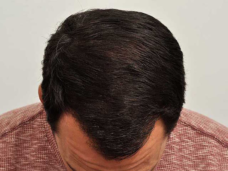 Hair Transplant 2910 grafts FUE
