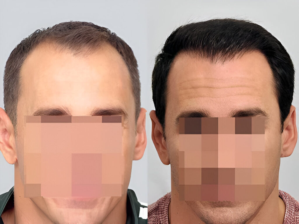 Hair Transplant 2910 grafts FUE