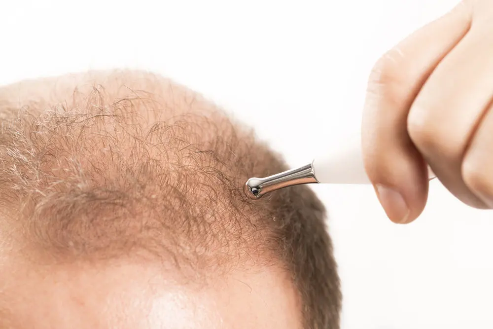 Baldness Alopecia man hair loss