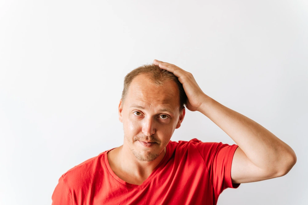 Young bald man with hair loss problems holding his head