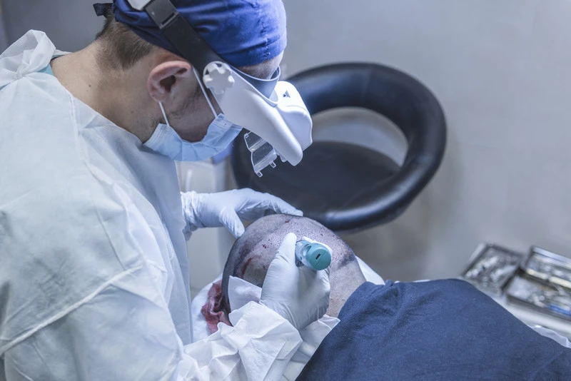 Amniotic Membrane for Hair Loss