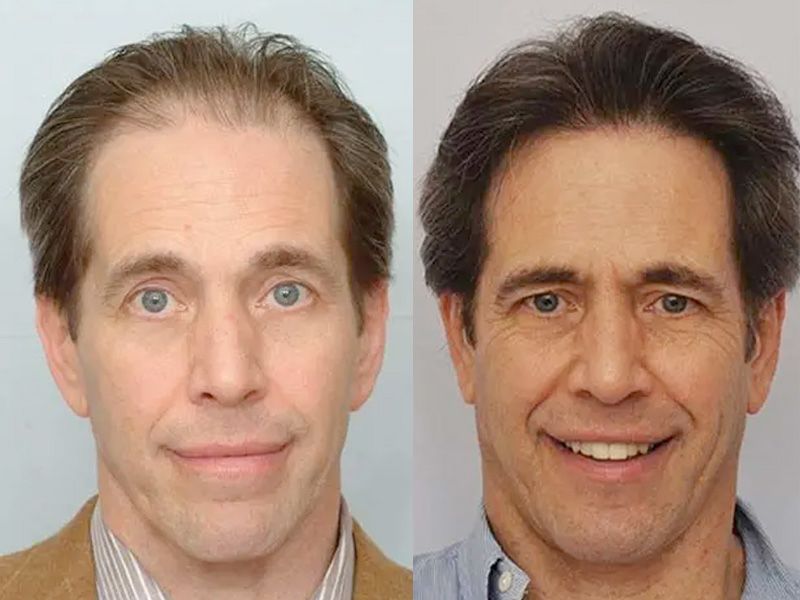 Hair Transplant 2701 grafts FUE front