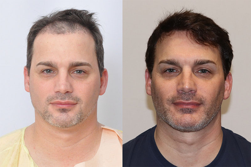 Hair Transplant 2717 grafts FUE featured