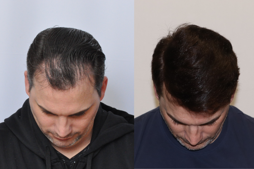 Hair Transplant 2717 grafts FUE