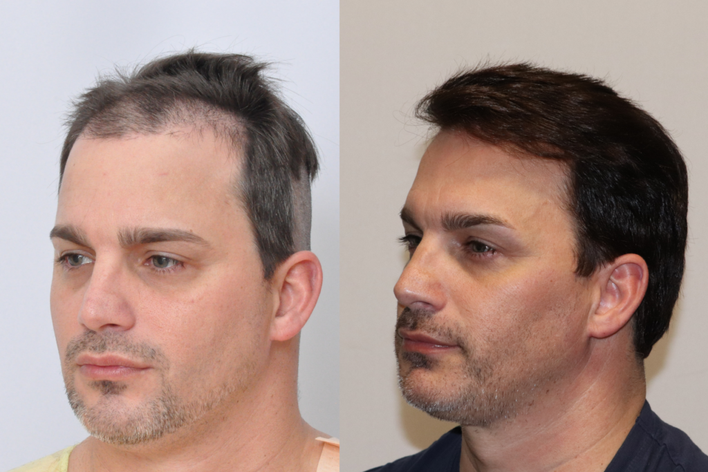 Hair Transplant 2717 grafts FUE