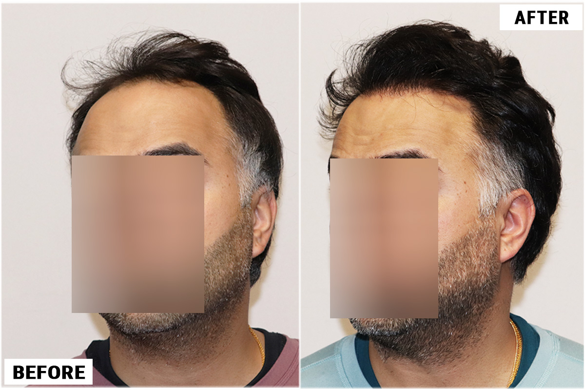 Hair Transplant 3178 grafts FUE