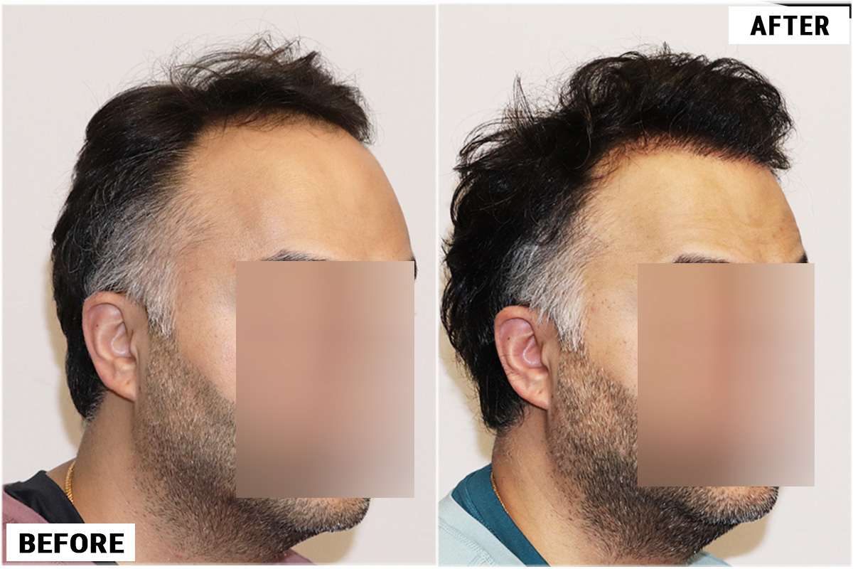 Hair Transplant 3178 grafts FUE