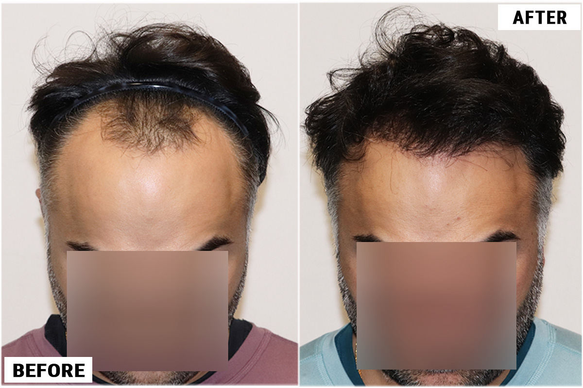 Hair Transplant 3178 grafts FUE